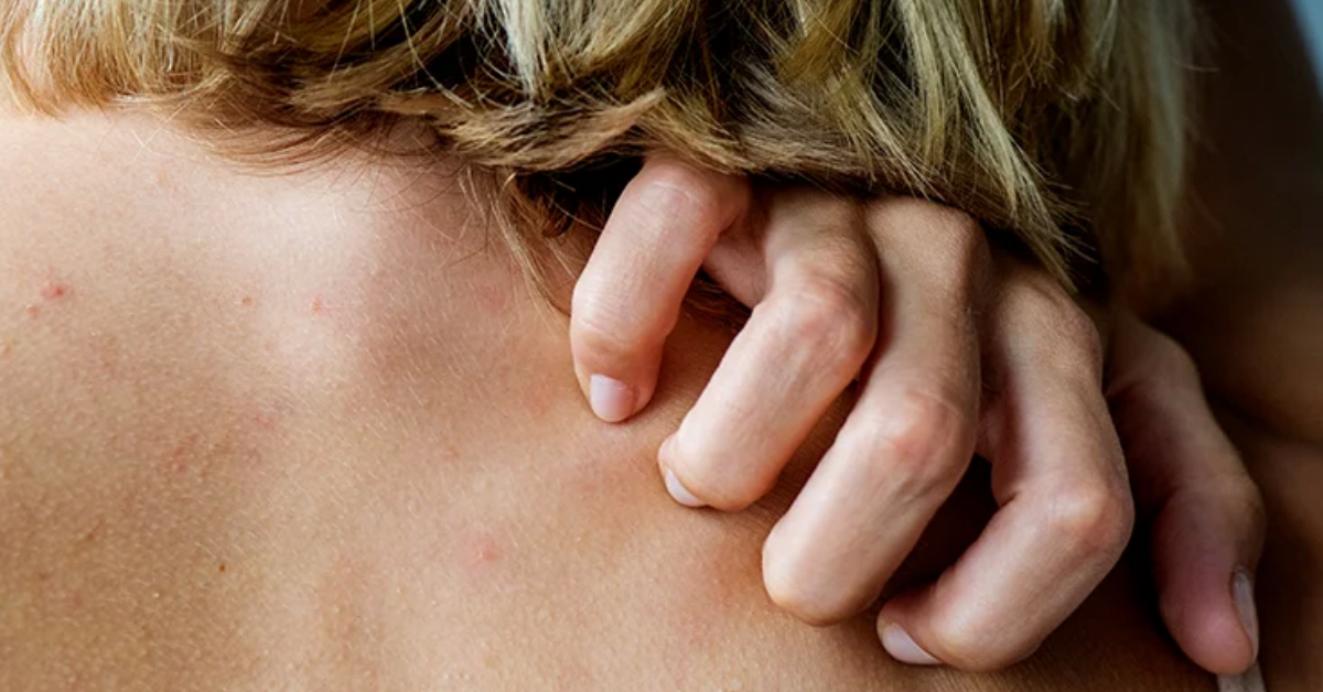 gluten rash